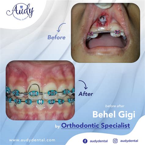 jenis behel bracket metal mini orthodontic|jenis behel tradisional.